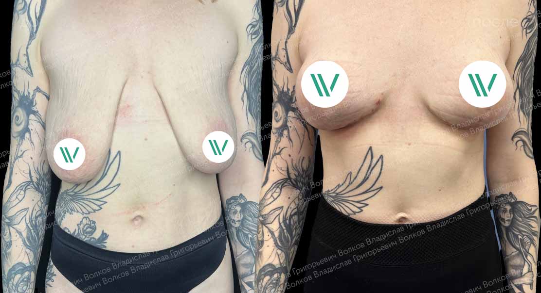 Якорная подтяжка груди