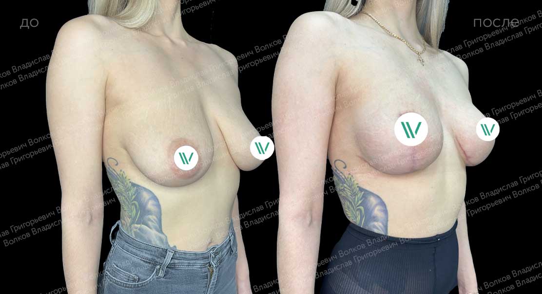 Подтяжка груди