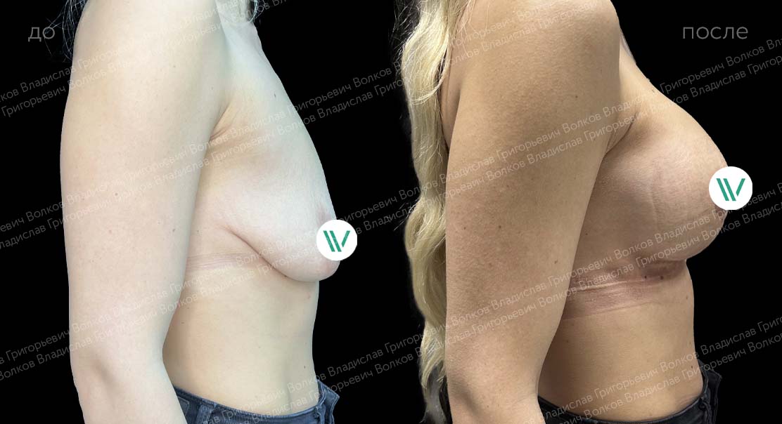 Увеличение груди с подтяжкой