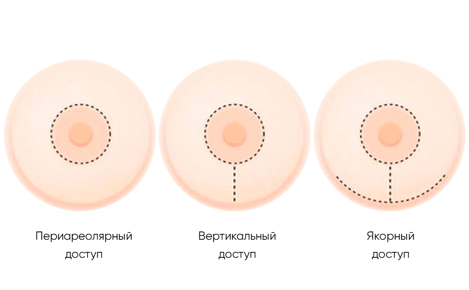 положение импланта в мягких тканях