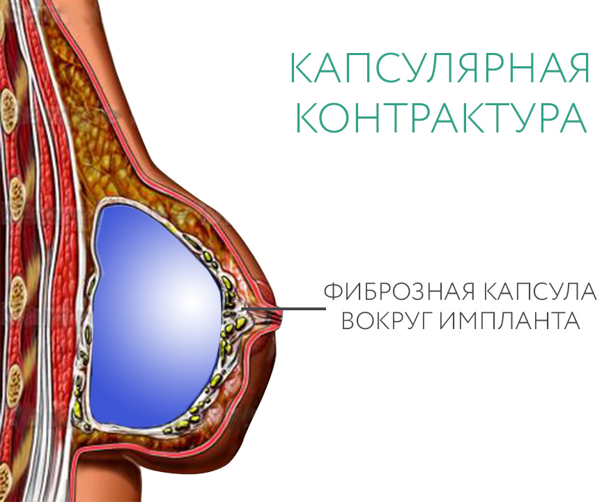 осложнение после маммопластики «капсулярная контрактура»