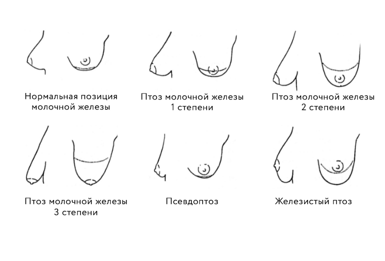 как определить степень птоза груди