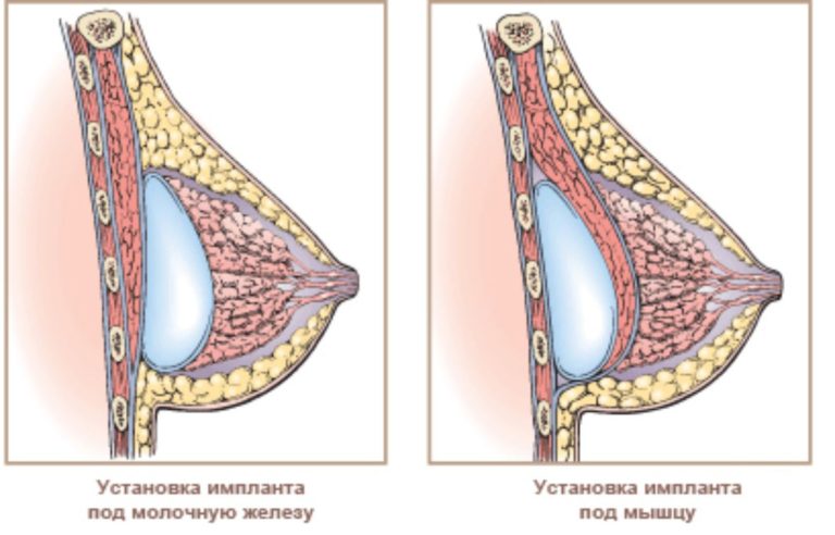 способы установки грудных имплантов