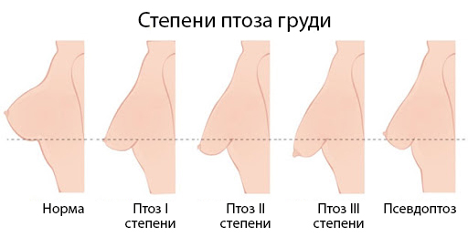 степени птоза молочных желез