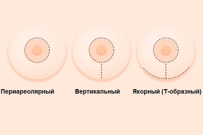 виды мастопексии