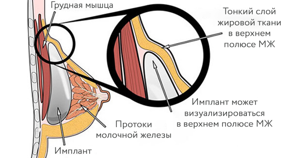 контурирование импланта маммопластика